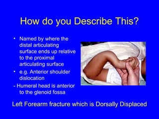 How do you Describe This? 
• Named by where the 
distal articulating 
surface ends up relative 
to the proximal 
articulating surface 
• e.g. Anterior shoulder 
dislocation 
- Humeral head is anterior 
to the glenoid fossa 
Left Forearm fracture wwhhiicchh iiss DDoorrssaallllyy DDiissppllaacceedd 
 