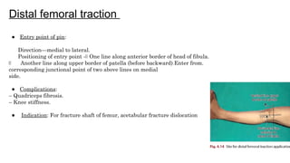 Distal Traction Rotation Comprehensive Overview of Splints and Traction Techniques in ...
