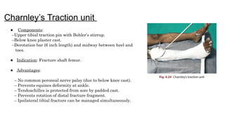 Comprehensive Overview of Splints and Traction Techniques in ...