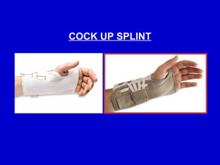 Comprehensive Guide to Splints and Traction Procedures in Orthopaedics ...