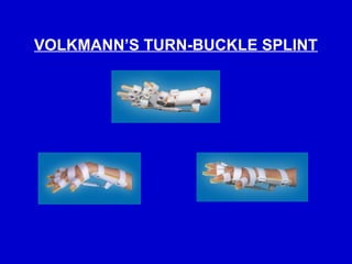 Comprehensive Guide to Splints and Traction Procedures in Orthopaedics ...
