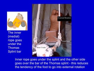 Splint Rope Comprehensive Guide to Splints and Traction Procedures in Orthopaedics ...
