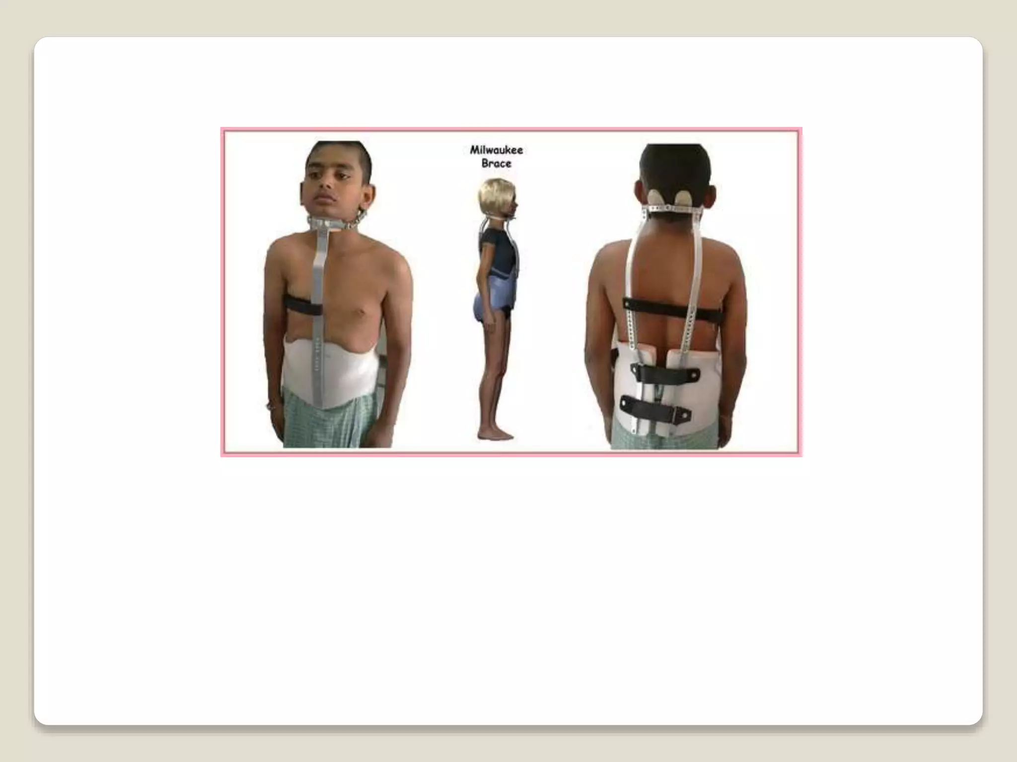 Splints and tractions | PPT