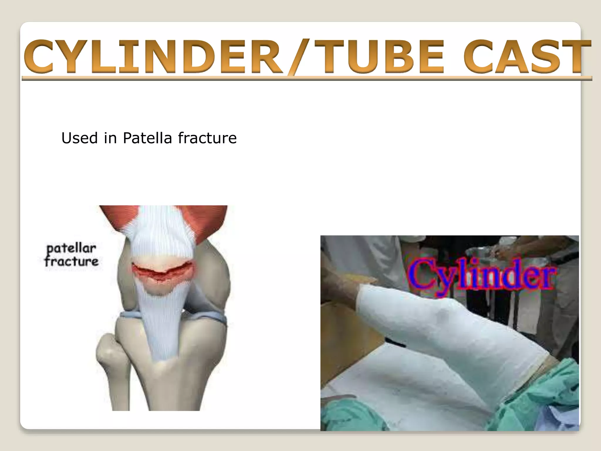 Splints and tractions | PPT