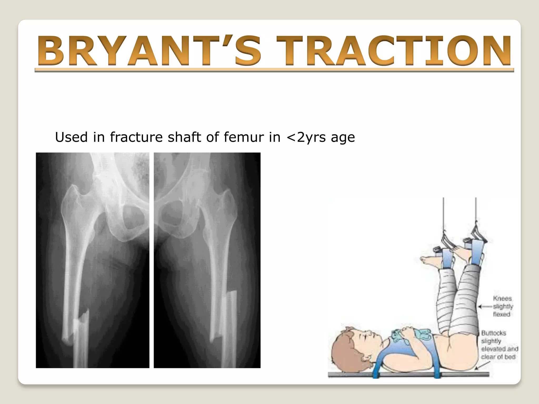 Used in fracture shaft of femur in <2yrs age
 