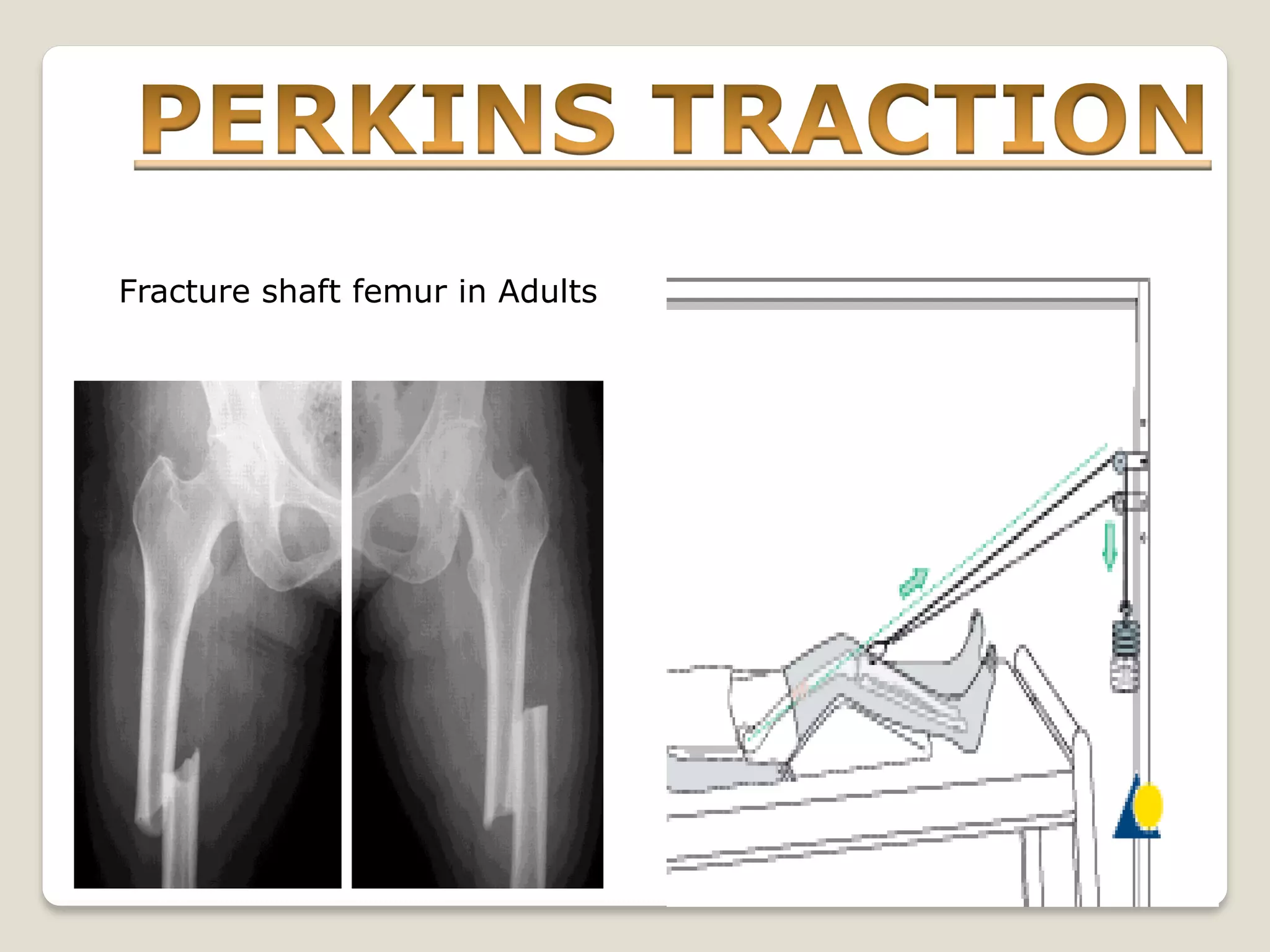 Fracture shaft femur in Adults
 