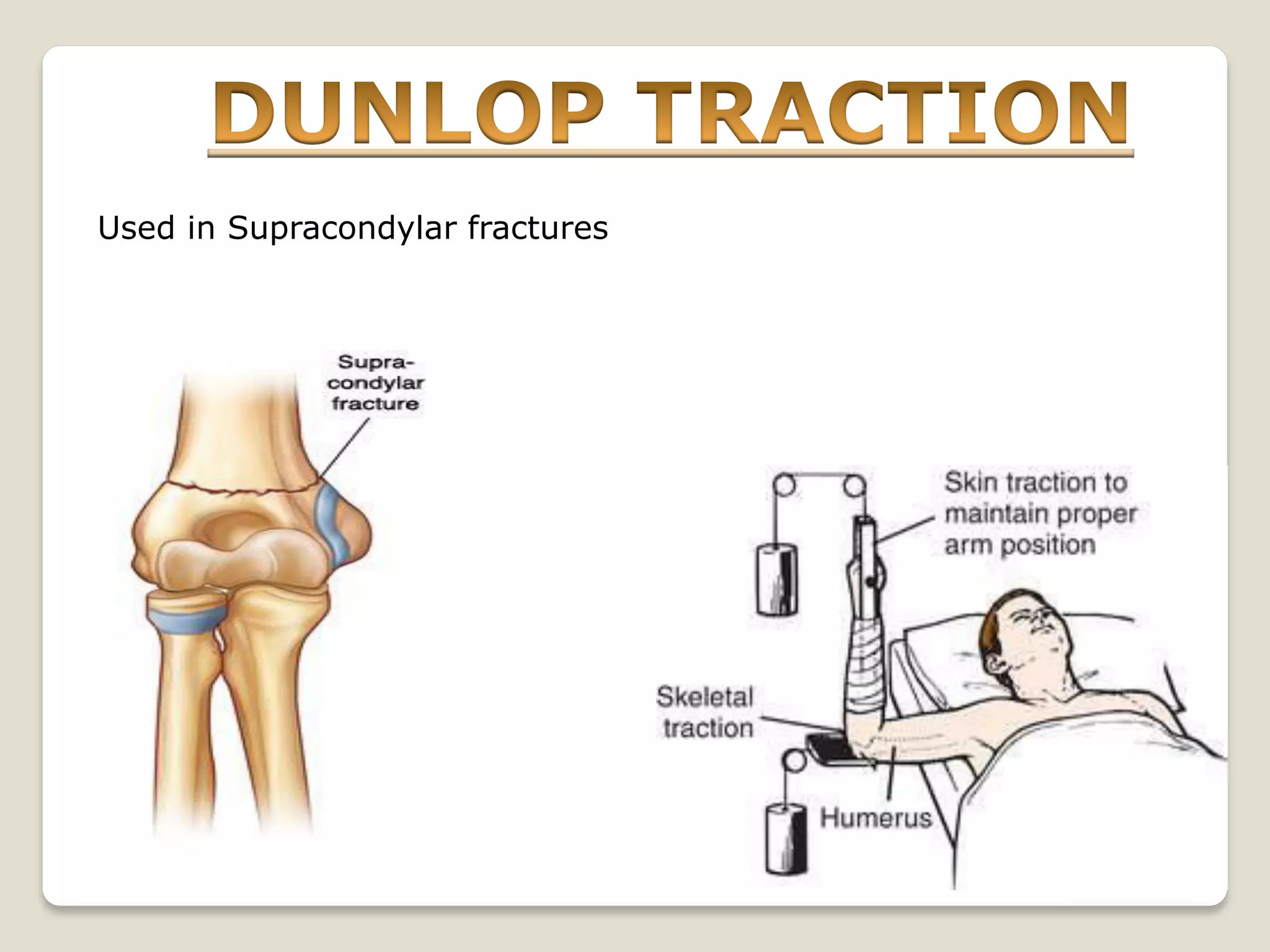 Used in Supracondylar fractures
 