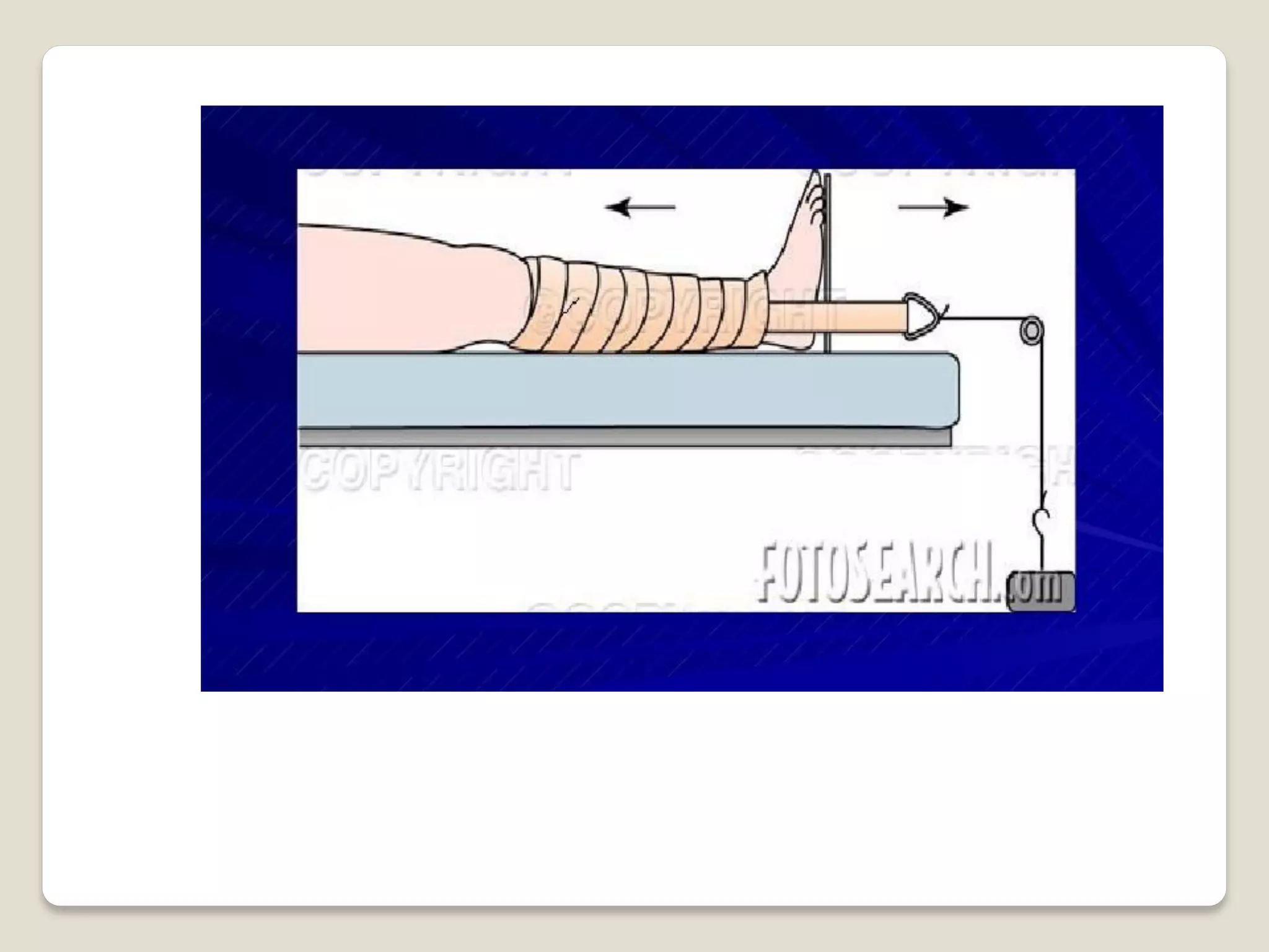 Splints and tractions