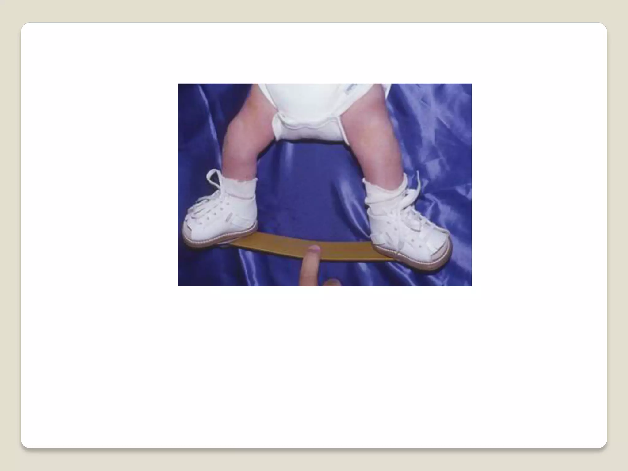 Splints and tractions