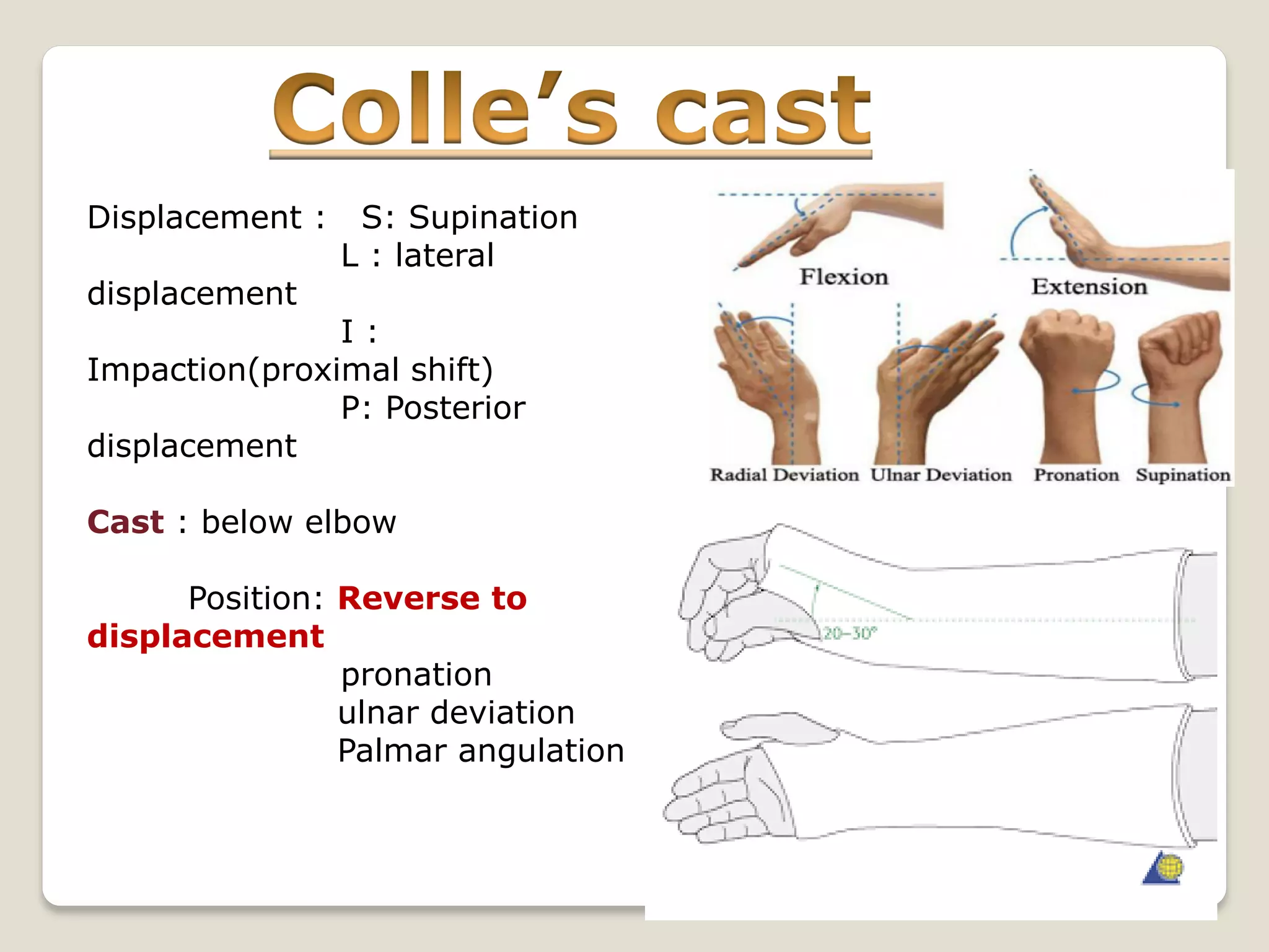 Displacement : S: Supination
L : lateral
displacement
I :
Impaction(proximal shift)
P: Posterior
displacement
Cast : below elbow
Position: Reverse to
displacement
pronation
ulnar deviation
Palmar angulation
 