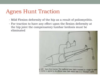 Agnes Hunt Traction
• Mild Flexion deformity of the hip as a result of poliomyelitis.
• For traction to have any effect upon the flexion deformity at
the hip joint the compensatory lumbar lordosis must be
eliminated
 