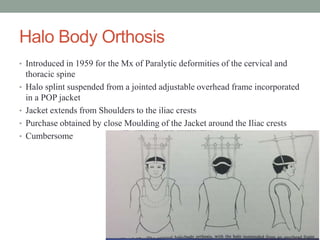 Halo Body Orthosis
• Introduced in 1959 for the Mx of Paralytic deformities of the cervical and
thoracic spine
• Halo splint suspended from a jointed adjustable overhead frame incorporated
in a POP jacket
• Jacket extends from Shoulders to the iliac crests
• Purchase obtained by close Moulding of the Jacket around the Iliac crests
• Cumbersome
 