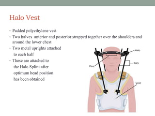 Halo Vest
• Padded polyethylene vest
• Two halves anterior and posterior strapped together over the shoulders and
around the lower chest
• Two metal uprights attached
to each half
• These are attached to
the Halo Splint after
optimum head position
has been obtained
 