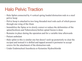 Halo Pelvic Traction
• Halo Splint connected by 4 vertical spring loaded distraction rods to a steel
pelvic hoop
• Pelvic hoop is attached to two long threaded steel rods each of which passes
through one wing of the ilium
• Immobilize the Spine or to slowly correct or reduce the deformities of the
spine(Scoliosis and Tuberculosis) before spinal fusion is done
• Remains in place during the operation and for a variable time afterwards
• Patient ambulant
• Halo splint in this is similar one but doesn’t arch up posteriorly to clear the
occiput and instead it is drilled and tapped around it perimeter to accept
screws for the attachment of the distraction rods
• Under Endotracheal Anesthesia or Ketamine Hydrochloride
 