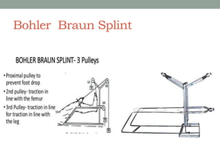 Bohler Braun Splint
 