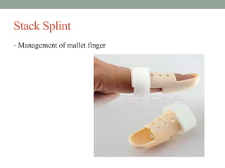 Stack Splint
• Management of mallet finger
 