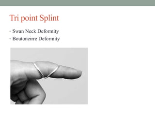 Tri point Splint
• Swan Neck Deformity
• Boutoneirre Deformity
 