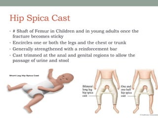 Hip Spica Cast
• # Shaft of Femur in Children and in young adults once the
fracture becomes sticky
• Encircles one or both the legs and the chest or trunk
• Generally strengthened with a reinforcement bar
• Cast trimmed at the anal and genital regions to allow the
passage of urine and stool
 
