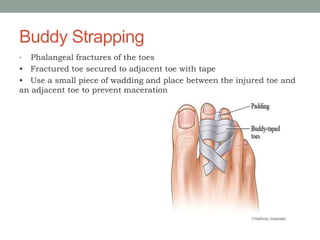 Buddy Strapping
• Phalangeal fractures of the toes
• Fractured toe secured to adjacent toe with tape
• Use a small piece of wadding and place between the injured toe and
an adjacent toe to prevent maceration
 