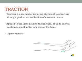 TRACTION
• Traction is a method of restoring alignment to a fracture
through gradual neutralisation of muscular forces
• Applied to the limb distal to the fracture, so as to exert a
continuous pull in the long axis of the bone
• Ligamentotaxis
 