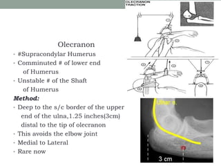 Olecranon
• #Supracondylar Humerus
• Comminuted # of lower end
of Humerus
• Unstable # of the Shaft
of Humerus
Method:
• Deep to the s/c border of the upper
end of the ulna,1.25 inches(3cm)
distal to the tip of olecranon
• This avoids the elbow joint
• Medial to Lateral
• Rare now
 
