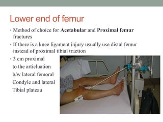 Lower end of femur
• Method of choice for Acetabular and Proximal femur
fractures
• If there is a knee ligament injury usually use distal femur
instead of proximal tibial traction
• 3 cm proximal
to the articluation
b/w lateral femoral
Condyle and lateral
Tibial plateau
 