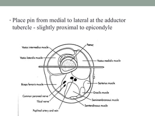 • Place pin from medial to lateral at the adductor
tubercle - slightly proximal to epicondyle
 