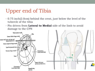 Upper end of Tibia
• 0.75 inch(2.0cm) behind the crest, just below the level of the
tubercle of the tibia
• Pin driven from Lateral to Medial side of the limb to avoid
damage to the CPN
 