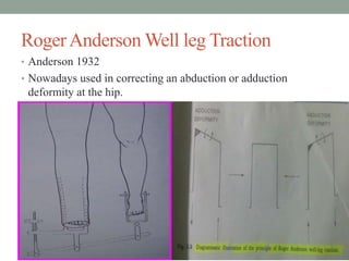 RogerAnderson Well leg Traction
• Anderson 1932
• Nowadays used in correcting an abduction or adduction
deformity at the hip.
 