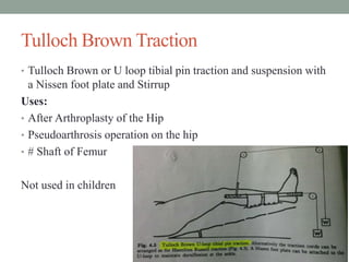 Tulloch Brown Traction
• Tulloch Brown or U loop tibial pin traction and suspension with
a Nissen foot plate and Stirrup
Uses:
• After Arthroplasty of the Hip
• Pseudoarthrosis operation on the hip
• # Shaft of Femur
Not used in children
 