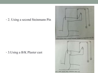 • 2. Using a second Steinmann Pin
• 3.Using a B/K Plaster cast
 
