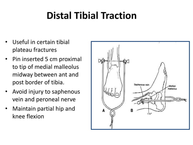 Distal Traction Rotation SPLINTS AND TRACTIONS IN ORTHOPAEDICS BY DR ATUL.pptx