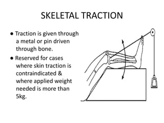 Traction Use Splints and tractions in orthopedics | PPTX
