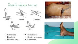 Sites for skeletal traction
• Calcaneum
• Distal tibia
• Proximal tibia
• Distal femur
• Greater trochanter
• Olecranon
 