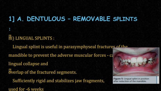 splints .pptx