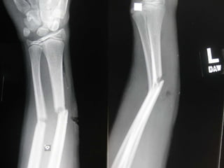splint the children.ppt
