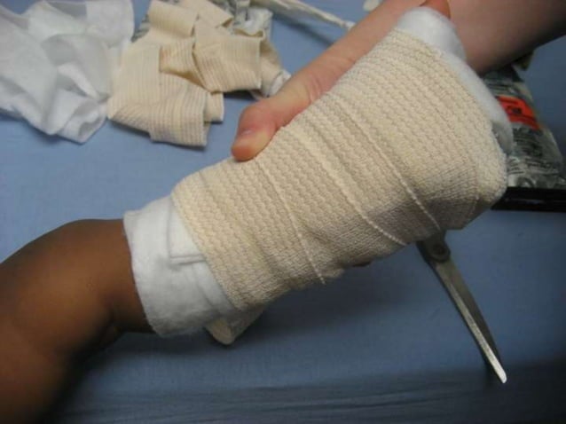 splint the children.ppt