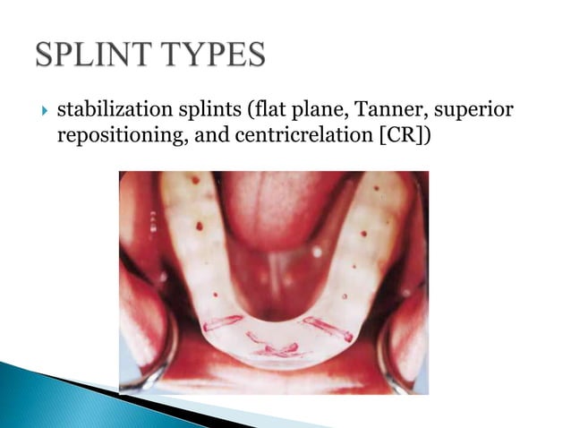 Tmj Splint Ramp Splint therapy for tmj disc displacement | PPTX | Physical Therapy ...