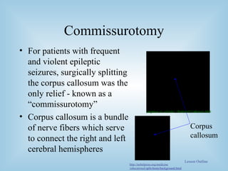Commissurotomy For patients with frequent and violent epileptic seizures, surgically splitting the corpus callosum was the only relief - known as a “commissurotomy” Corpus callosum is a bundle of nerve fibers which serve to connect the right and left cerebral hemispheres Corpus  callosum Lesson Outline pegasus.cc.ucf.edu/ ~Brainmd1/callosum.html http://nobelprize.org/medicine /educational/ split-brain/background.html 