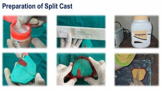 Split Cast Method SPLIT CAST TECHNIQUE for complete denture mounting | PPTX