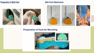 Split Cast Method SPLIT CAST TECHNIQUE for complete denture mounting | PPTX