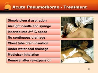 Acute Pneumothorax - Treatment26