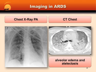 Imaging in ARDS29