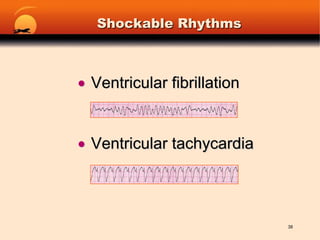 Shockable RhythmsVentricular fibrillation