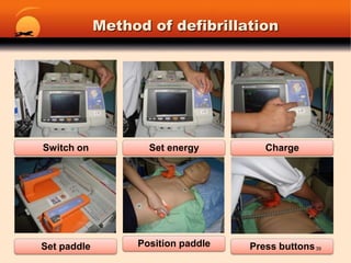 Ventricular tachycardia38
