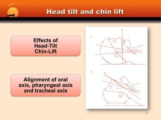 Head tilt and chin lift7