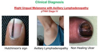 Case Of Right Ungal Malignant Melanoma PPTX case-of-right-ungal-malignant-melanoma-pptx