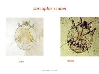 sarcoptes scabei
FemaleMale
TONY SCARIA 2010 KMC
 