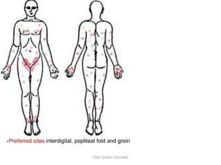 Preferred sites interdigital, popliteal fold and groin
TONY SCARIA 2010 KMC
 