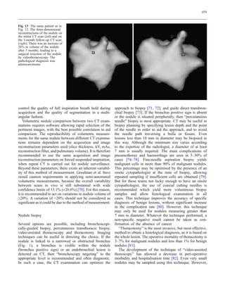 459



Fig. 13 The same patient as in
Fig. 12. The three-dimensional
reconstructions of the nodule on
the initial CT scan (left) and on
the 3-month follow-up CT scan
(right). There was an increase of
26% in volume of the nodule
after 3 months, leading to a
surgical resection of the nodule
by videothoracoscopy. The
pathological diagnosis was
adenocarcinoma




control the quality of full inspiration breath hold during      approach to biopsy [71, 72], and guide direct transbron-
acquisition and the quality of segmentation in a multi-         chial biopsy [73]. If the bronchus positive sign is absent
angular fashion.                                                or the nodule is situated peripherally, then “percutaneous
    Volumetric nodule comparison between two CT exam-           needle” biopsy is most appropriate. CT may be useful in
inations requires software allowing rapid selection of the      biopsy planning by specifying lesion depth and the point
pertinent images, with the best possible correlation to aid     of the needle in order to aid the approach, and to avoid
comparison. The reproducibility of volumetric measure-          the needle path traversing a bulla or fissure. Even
ments for the same nodule between different CT examina-         lesions less than 10 mm in diameter may be biopsied in
tions remains dependent on the acquisition and image            this way. Although the minimum size varies according
reconstruction parameters used (slice thickness, kV, mAs,       to the expertise of the radiologist, a diameter of at least
reconstruction filter, and pulmonary volume). It is therefore   7 mm is usually required. The main complications of
recommended to use the same acquisition and image               pneumothorax and haemorrhage are seen in 5–30% of
reconstruction parameters on forced suspended inspiration,      cases [74–78]. Fine-needle aspiration biopsy yields
when repeat CT is carried out for nodule surveillance.          malignant cells in more than 90% of malignant nodules.
Beyond these parameters, there exists an inherent variabil-     This percentage may be optimised by the presence of an
ity of this method of measurement. Goodman et al. have          onsite cytopathologist at the time of biopsy, allowing
raised caution requirements in applying semi-automated          repeated sampling if insufficient cells are obtained [79].
volumetric measurements, because the overall variability        But for those teams not lucky enough to have an onsite
between scans in vivo is still substantial with wide            cytopathologist, the use of coaxial cutting needles is
confidence limits of 13.1% (±26.6%) [70]. For this reason,      recommended which yield more voluminous biopsy
it is recommended to act on variations in nodule volume of      samples and allow histological examination in all
≥20%. A variation of 20% should not be considered as           cases. This technique improves the accuracy of specific
significant as it could be due to the method of measurement.    diagnosis of benign lesions, without significant increase
                                                                in the complication rate [80]. However, this technique
                                                                may only be used for nodules measuring greater than
Nodule biopsy                                                   7 mm in diameter. Whatever the technique performed, a
                                                                non-specific negative result cannot be taken as con-
Several options are possible, including bronchoscopi-           firmation of the absence of cancer.
cally-guided biopsy, percutaneous transthoracic biopsy,            “Thoracotomy” is the most invasive, but most effective,
video-assisted thoracoscopy and thoracotomy. Imaging            method to obtain a histological diagnosis, as it is based on
techniques can be useful in directing the choice. If the        the whole lesion. The operative mortality of thoracotomy is
nodule is linked to a narrowed or obstructed bronchus           3–7% for malignant nodules and less than 1% for benign
(Fig. 1), a bronchus is visible within the nodule               nodules [81].
(bronchus positive sign) or an endobronchial lesion is             The development of the technique of “video-assisted
detected on CT, then “bronchoscopy targeting” to the            thoroscopy” has allowed a decrease in peri-operative
appropriate level is recommended and often diagnostic.          morbidity and hospitalisation time [82]. Even very small
In such a case, the CT examination can optimize the             nodules may be sampled using this technique. However,
 